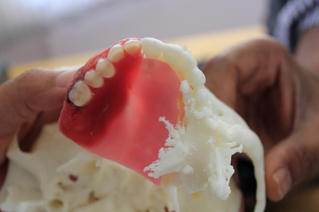 A replica of a man's mouth was 3D printed and used as a template to produce a wax model, which was then hardened and fitted with teeth