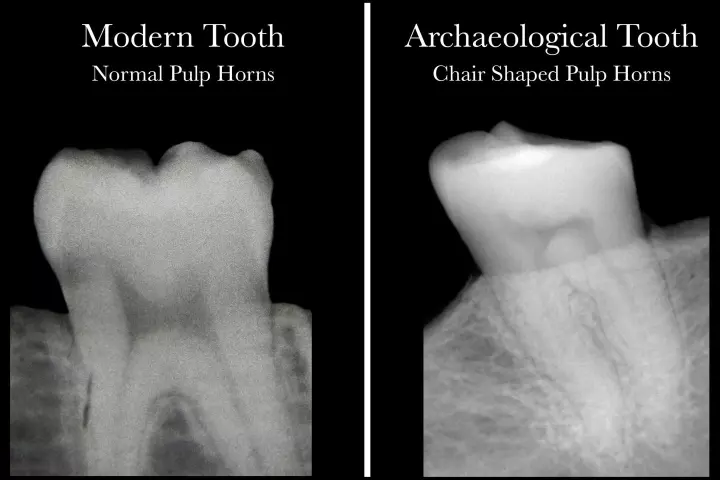 A modern healthy tooth with pulp "horns" (left), and an archeological tooth indicating a lack of vitamin D