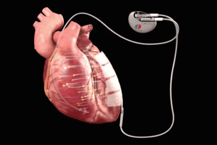 The device incorporates two electrodes, which are attached to the heart