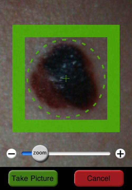 MelApp uses the iphone's camera to take a picture of suspicious moles or freckles
