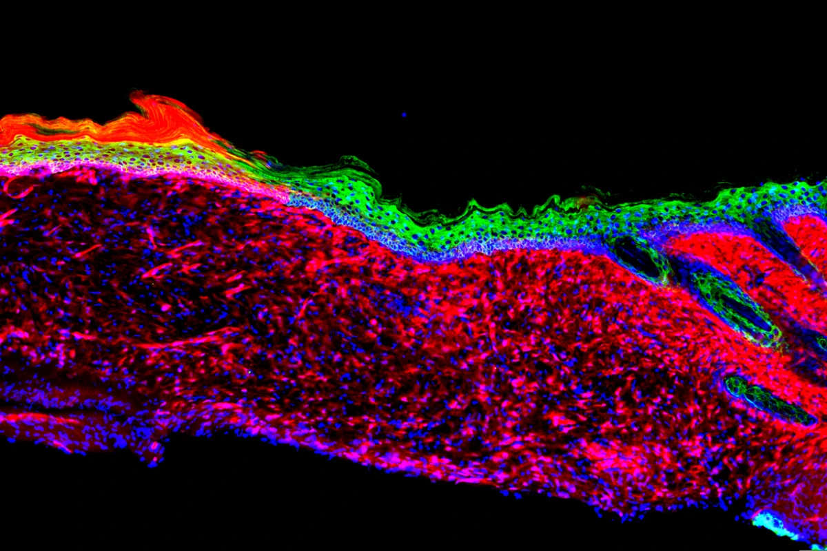 Salk Institute scientists converted one type of cell (seen in red) into basal keratinocytes (green), a precursor to healthy skin cells