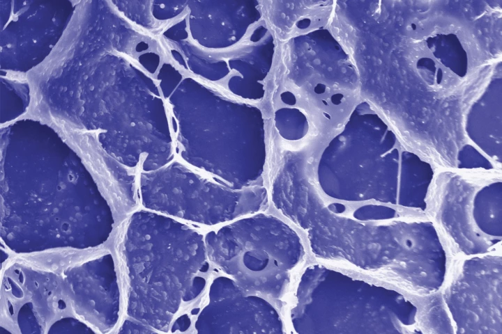 The gel helps the immune system target and kill any cancer cells that remain after tumor-removal surgery