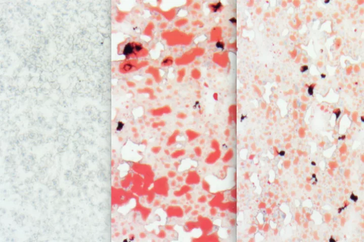 A comparison of the livers of different groups of mice – left is a healthy mouse liver, middle shows the fatty deposits (red) left by a high-fat/cholesterol diet over 12 weeks, and the right image shows that same high-fat diet in mice with high levels of Aloxe3 expression