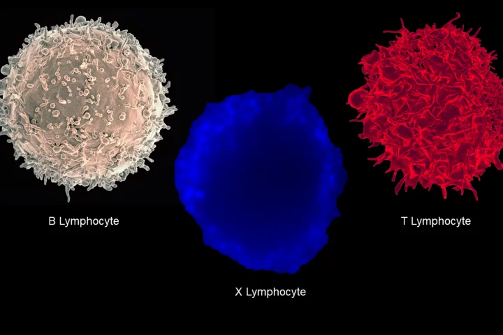 Colorized scanning electron micrographs of a B and T immune cells shown with a fluorescent microscopy image of the previously unseen new "hybrid" cell, thought to play a major role in the onset of type 1 diabetes