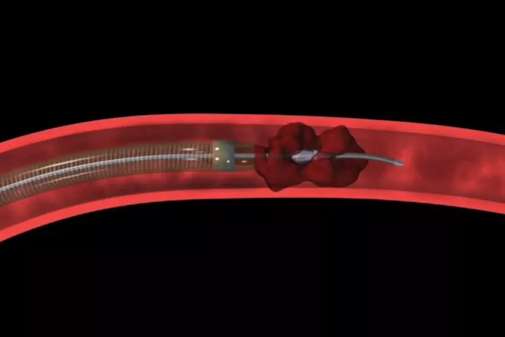 The Penumbra System of Continuous Aspiration Thrombectomy, sucking out a blood clot