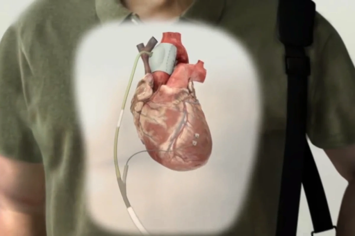The C-Pulse system is designed to take stress off the heart, by helping it circulate blood