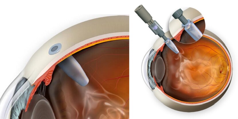The reservoir can be refilled via a circular port on the end of the device, which appears as a small dot on the surface of the eye, hidden beneath the eyelid