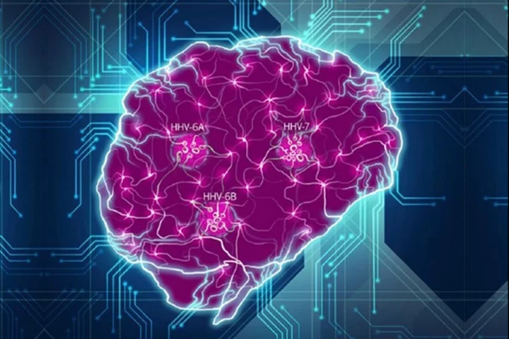 A new study has resurrected an old hypothesis suggesting the herpes simplex virus may play a major role in the onset of Alzheimer's disease