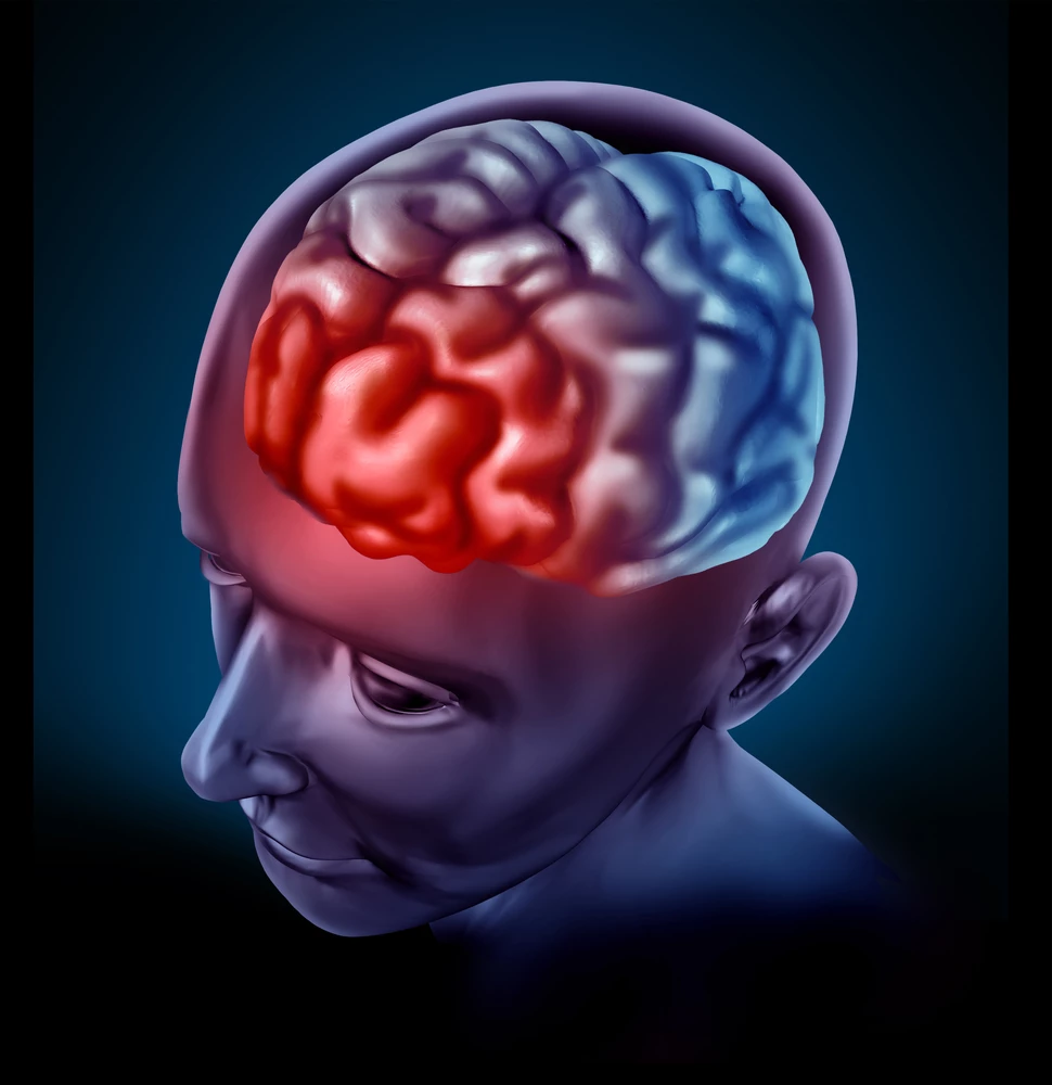 Researchers have identified a naturally occurring molecule that helps to slow the onset of Alzheimer’s disease (Image: Shutterstock)