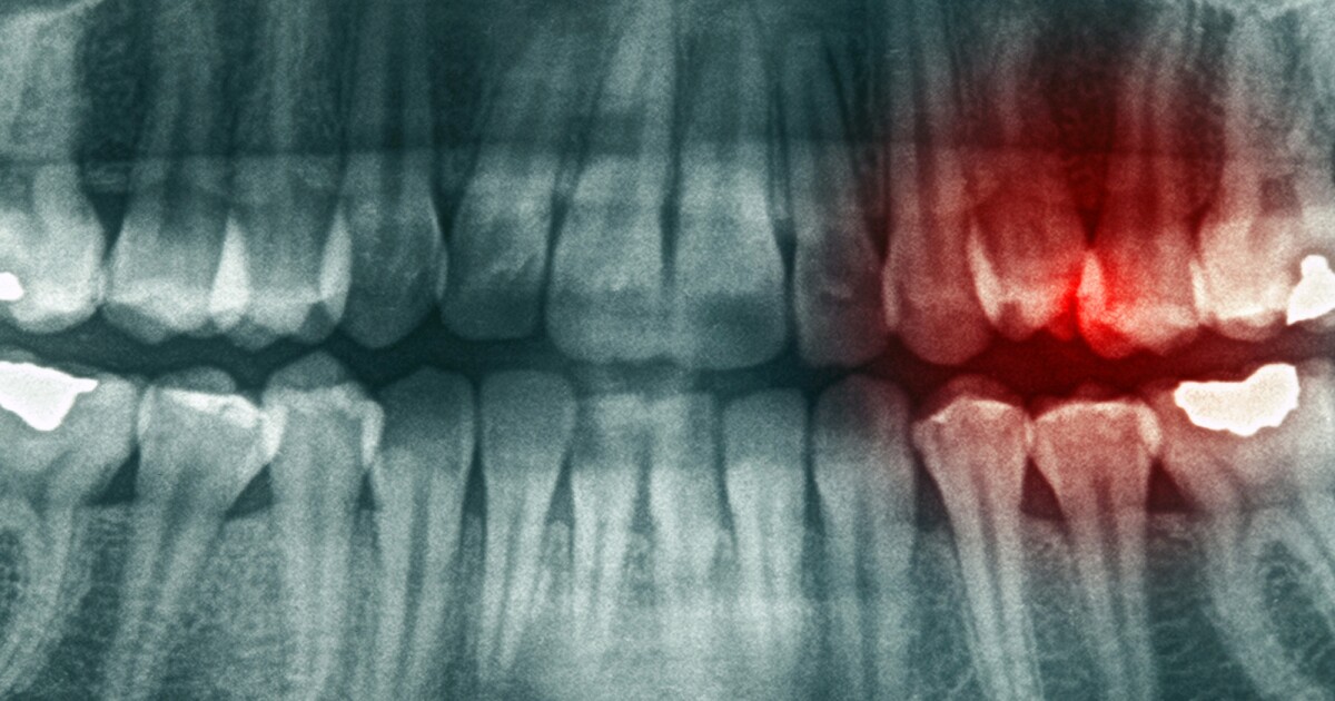 Exercise and omega-3s reduce tooth infection severity Exercise and omega-3s reduce tooth infection severity