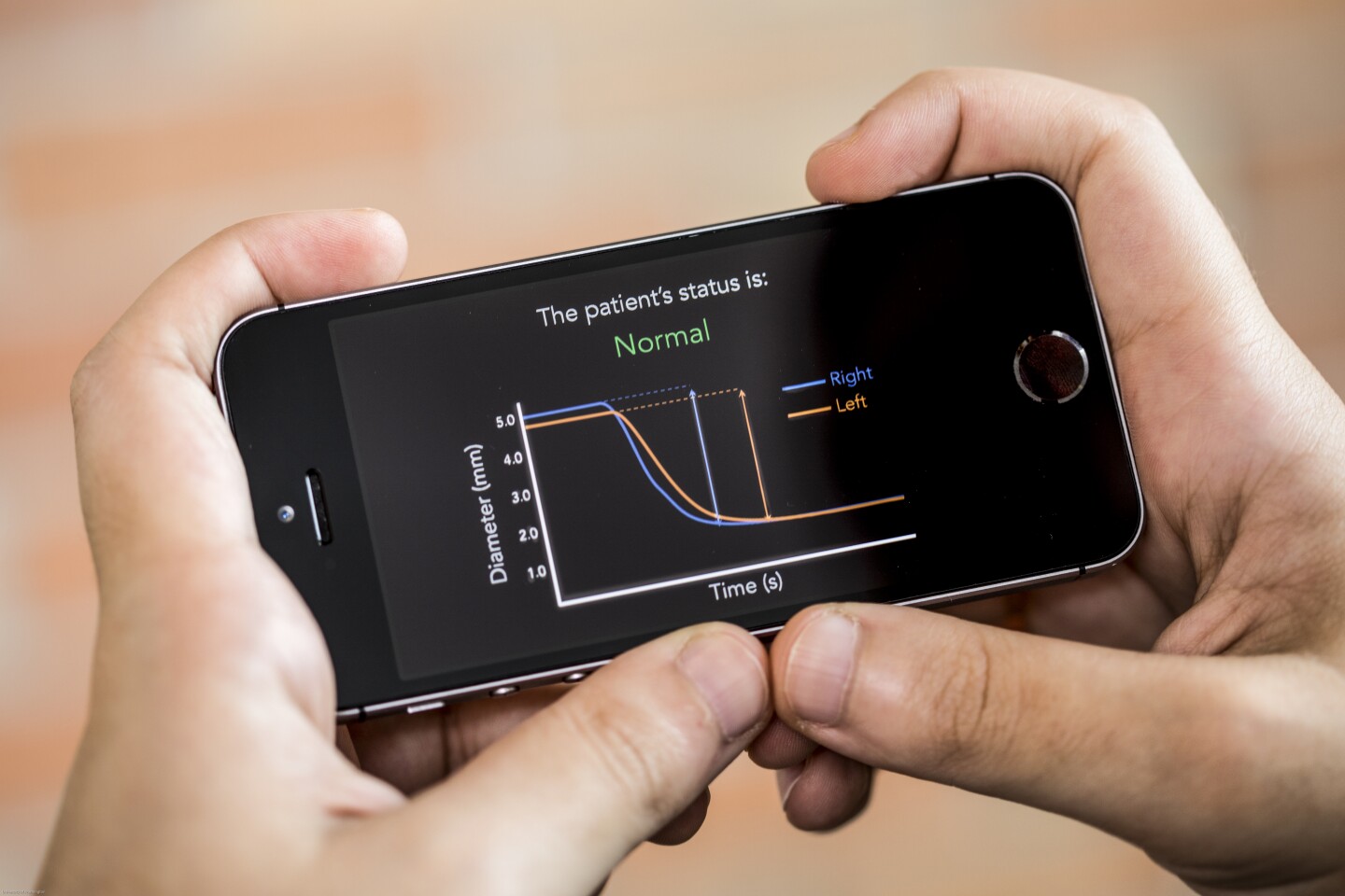 A smartphone app that can be used on the sidelines by coaches, parents and doctors to immediately screen for concussion would be a game-changer
