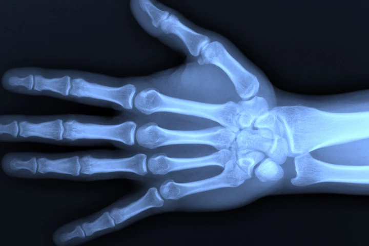 New technology based on the eye of a moth improves the quality of X-ray images without compromising the patient's safety (Photo: Shutterstock)