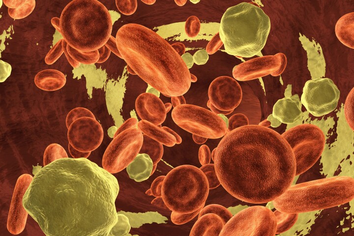 Clinical trials have shown that a single-dose drug can reduce lipoprotein(a) levels by 94% for almost a year