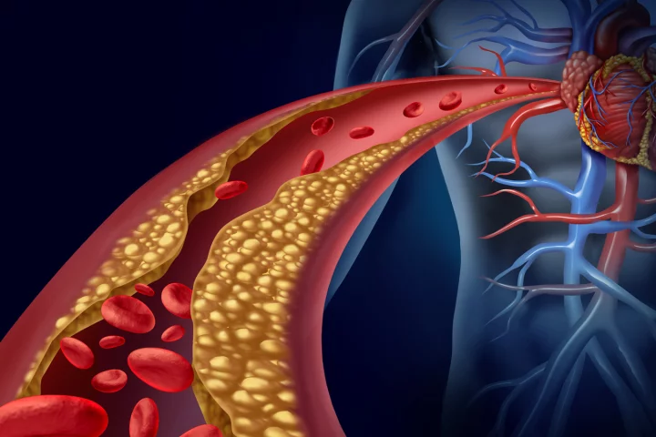 Nanometer-sized “drones” that deliver drugs to heal and stabilize fat deposits in arteries could become a new way to prevent heart attacks caused by atherosclerosis (Photo: Shutterstock)