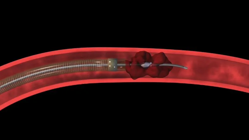 The Penumbra System of Continuous Aspiration Thrombectomy, sucking out a blood clot