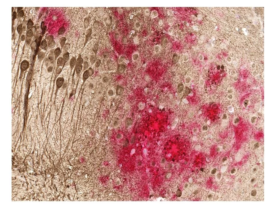 After success in three separate animal models an Alzheimer's vaccine is on the cusp of human trials. Toxic amyloid plaques (red) and tau tangles (brown) form on the brain of a mouse modeled to have the disease. A study shows a DNA vaccine reduces both amyloid and tau in the mouse AD model, with no adverse immune responses