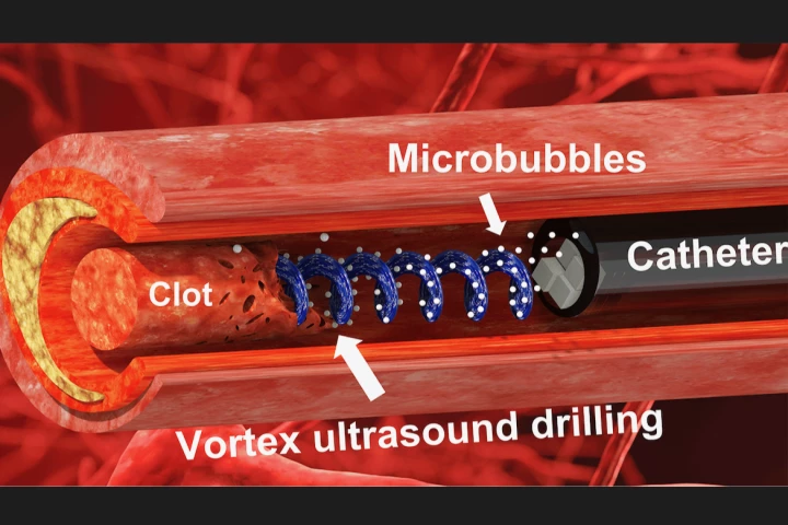 A diagram showing how the transducer could use "vortex ultrasound" to disintegrate blood clots in the brain