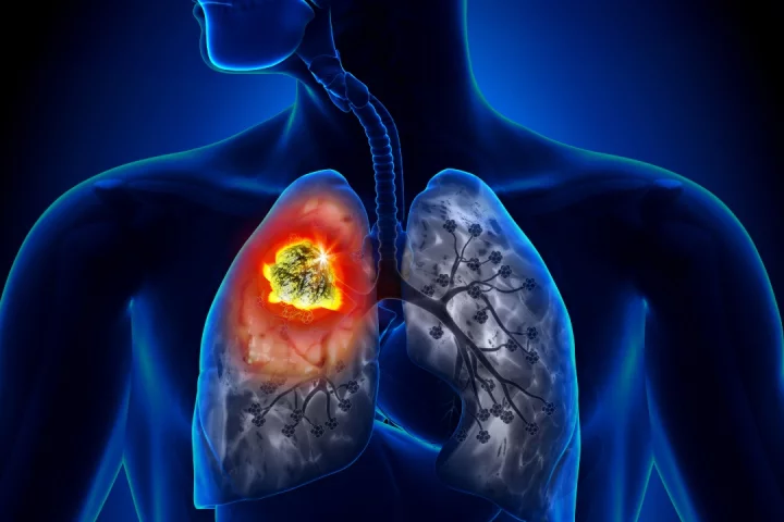 A new dual-drug treatment offers new hope in battling lung cancers