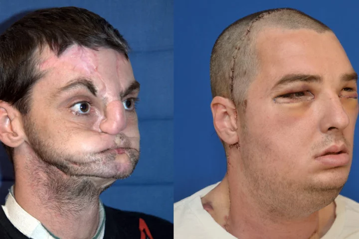 Remarkable transformation - before and after shots of the face transplant recipient (Photo: University of Maryland Medical Center)