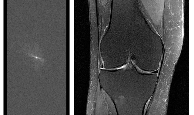 On the left is a single raw set of MRI data, and on the right is a fully reconstructed MRI image of a knee compiled from a number of sets of raw data