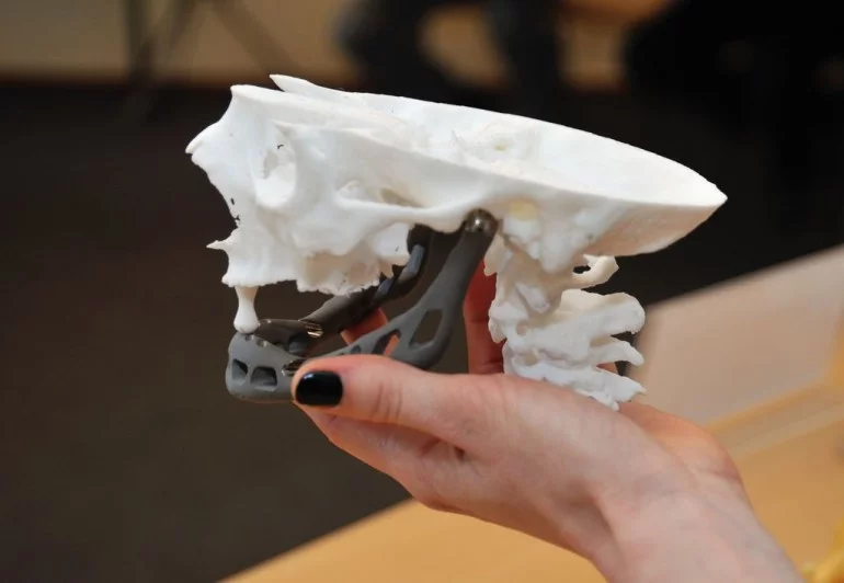 This titanium printed implant was designed for an 83-year old woman