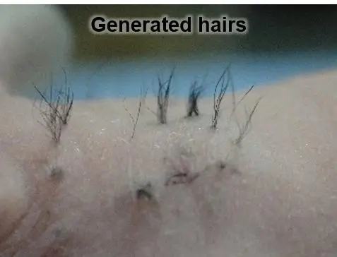 Scientists implanted their new hair follicle germs onto the backs of mice, with promising results