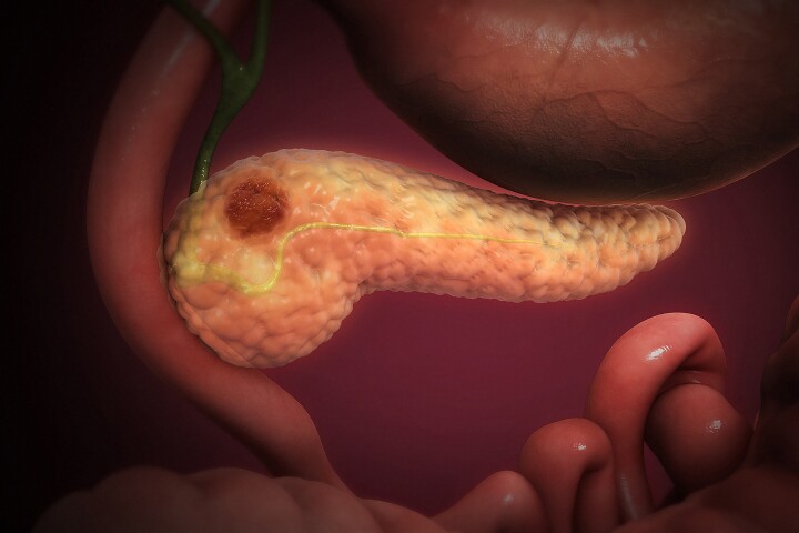 Researchers have found a way to starve pancreatic cancer cells, slowing their growth and spread