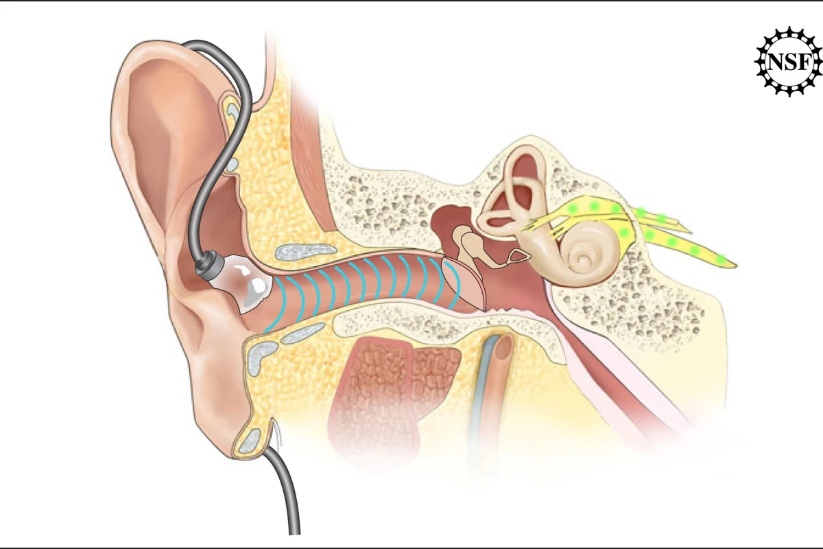 The ADEL features an inflatable tip, that is said to minimize or eliminate discomfort in the ears of music listeners (All images: Asius Technologies)