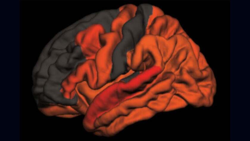 The red and orange shades illustrate the areas in the brain that display higher levels of toxic proteins aggregating in relation to reduced amounts of slow-wave sleep