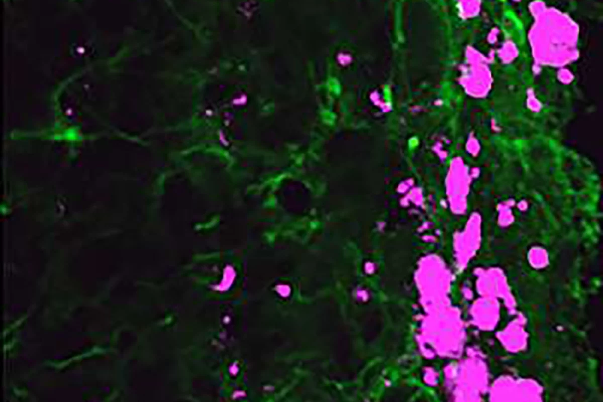 Reprogrammed stem cells (green) chase down and kill glioblastoma cells (pink)