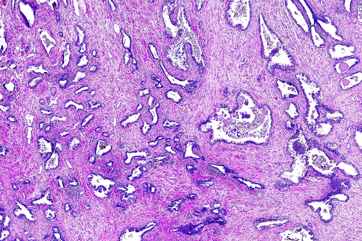 Researchers have found three new prostate cancer biomarkers that will assist pathologists to accurately grade the disease's severity