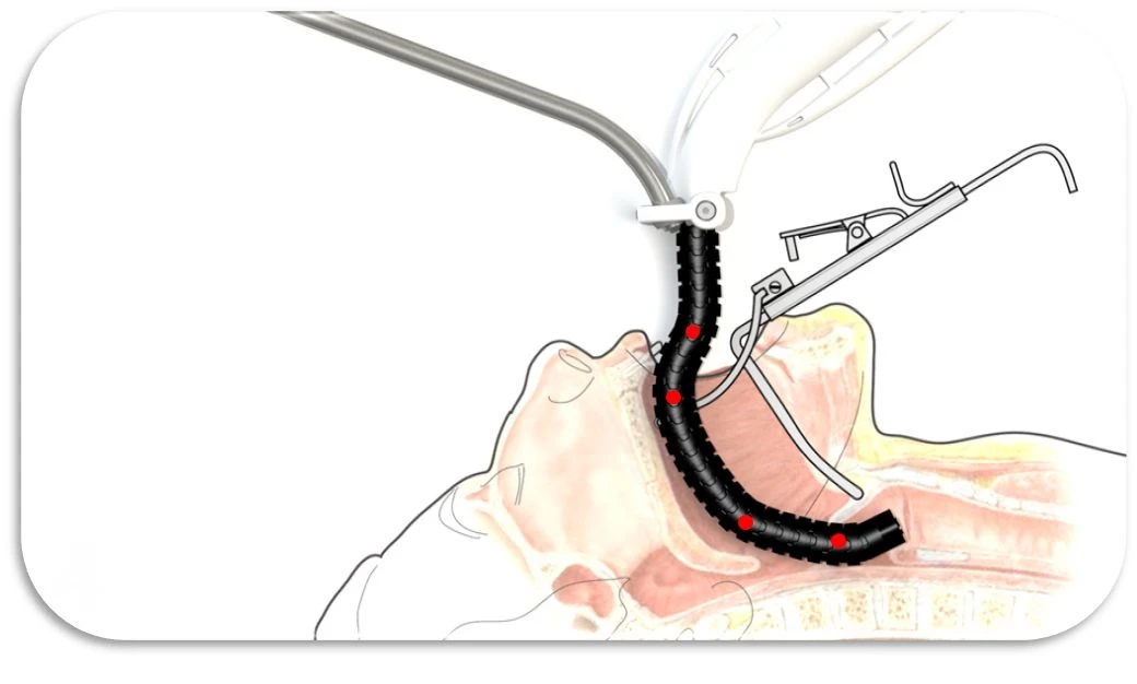 The Flex System enters the patient's body through their mouth
