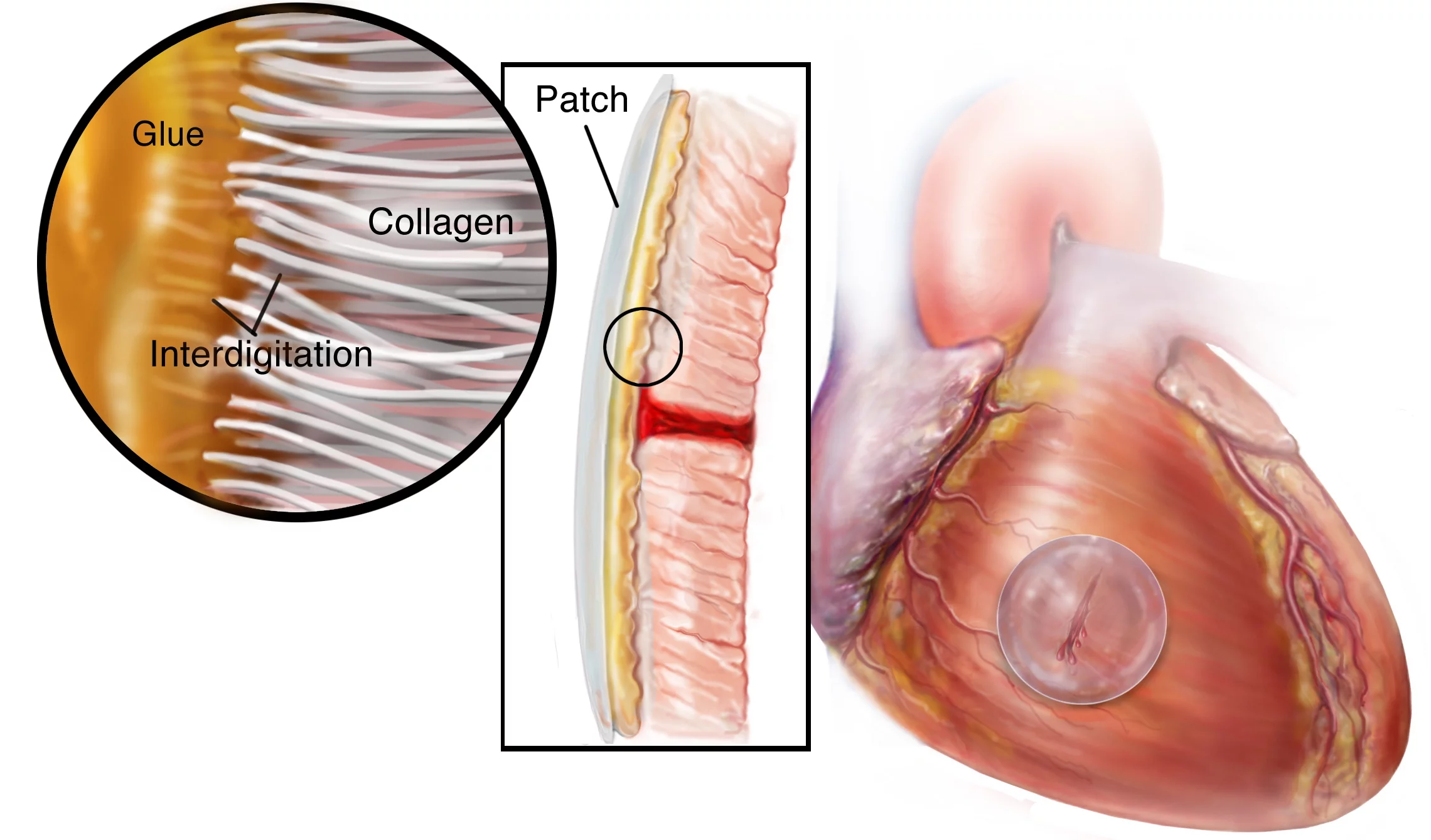 HLAA sets to an elastic consistency, and bonds with cardiac tissue