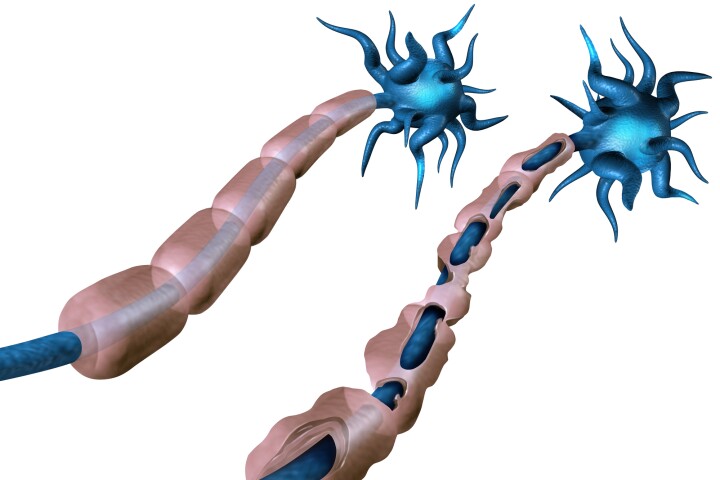 A new study has found direct evidence that an over-the-counter antihistamine can repair the nerve sheath damaged in people with multiple sclerosis