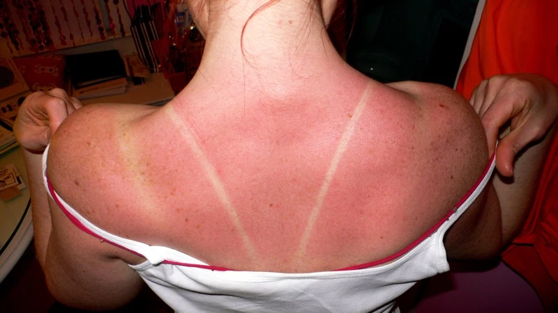 A new understanding of the workings of a DNA-repairing enzyme could lead to medications that heal sunburns (Photo: Kelly Sue DeConnick)