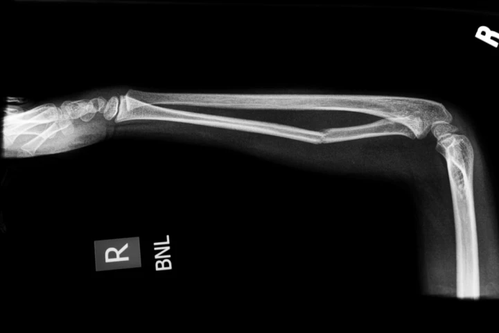 A new material known as "fracture putty" could be used to help broken bones heal much more quickly than is currently possible (Image: nelgdev)