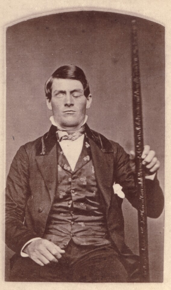 Phineas Gage posing with the tamping iron that shot through his head as the result of a premature explosion while blasting