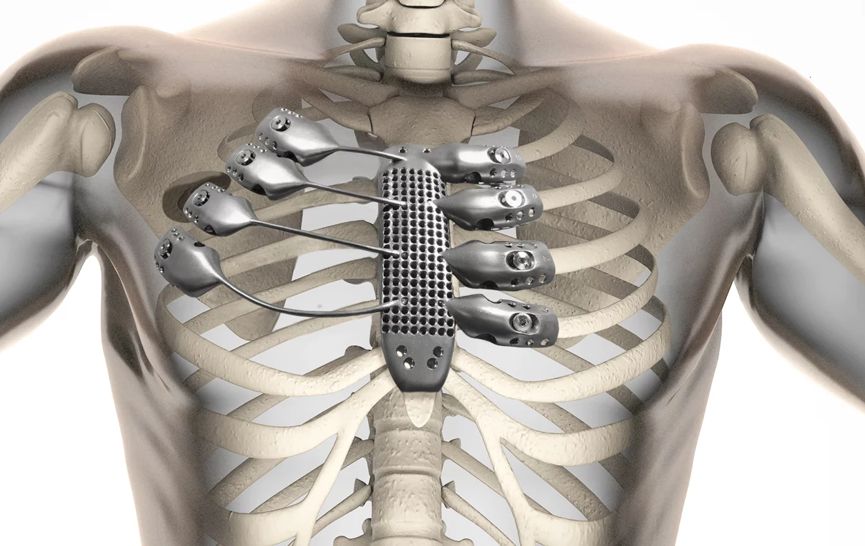 3D printing technology has enabled a replacement sternum and rib cage customized for a specific patient