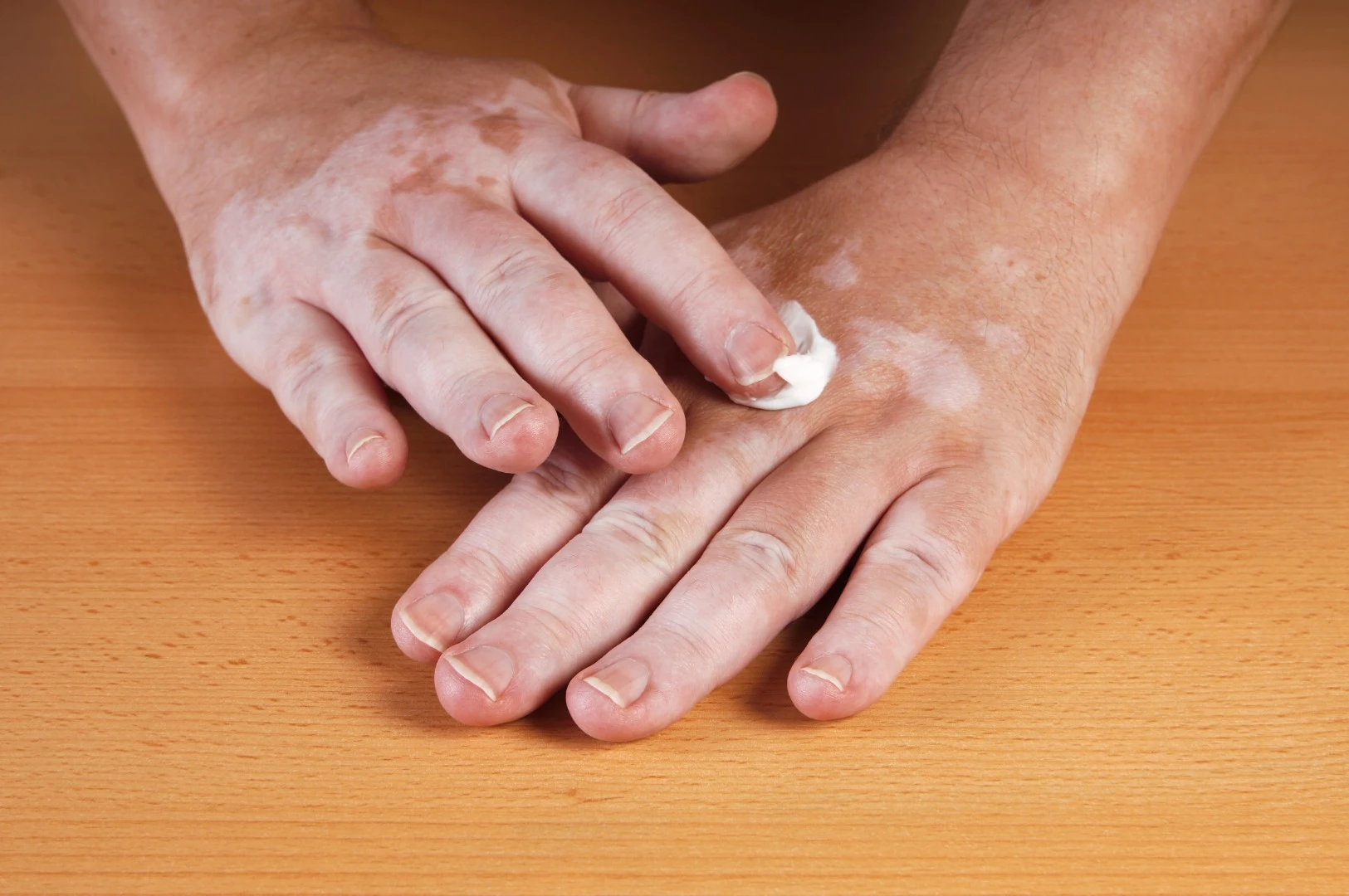 The medication was applied either once or twice daily, in the form of a cream