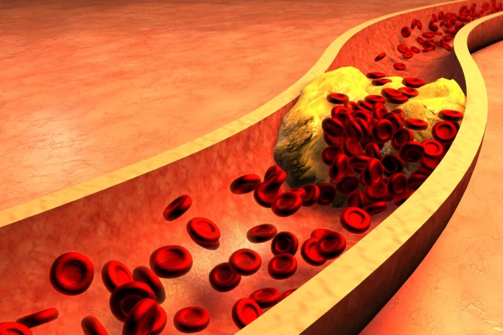 The Pantheris system can not only spot blockages in blood vessels, but it can help doctors shave them away as well