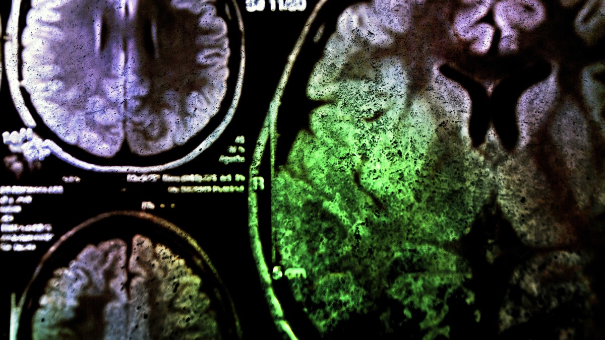 New approach shields memory from brain cancer radiotherapy