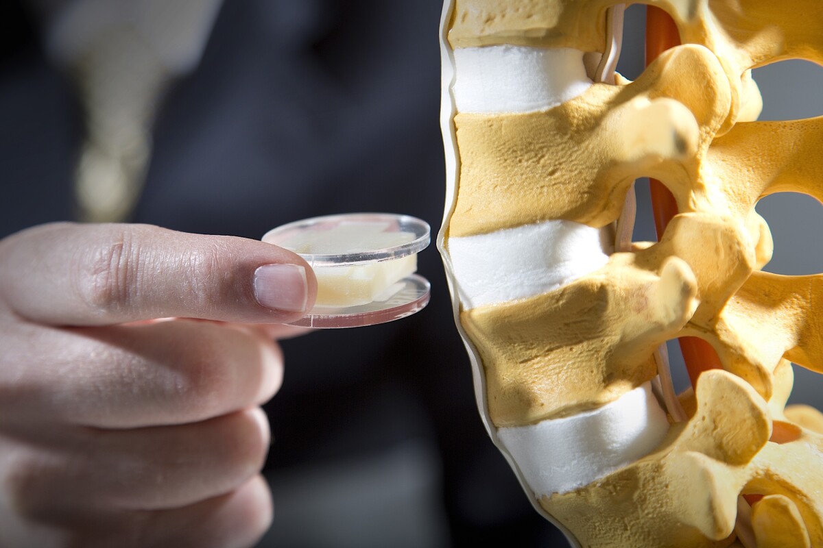 Artificial spinal disc designed to treat chronic lower back pain