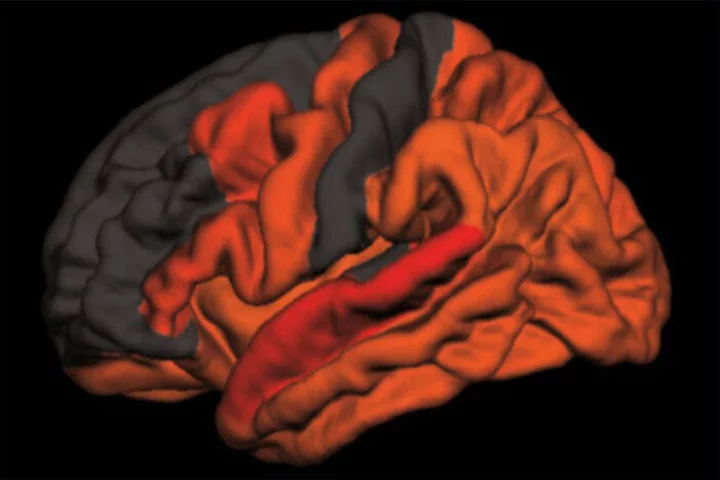 The red and orange shades illustrate the areas in the brain that display higher levels of toxic proteins aggregating in relation to reduced amounts of slow-wave sleep