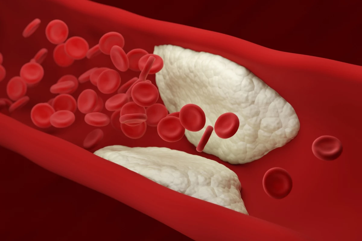 A study has shown that showing patients images of the plaque buildup in their arteries motivates them to address disease risk factors