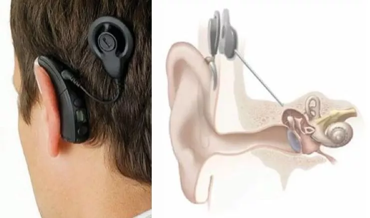 The external processor (left) and a diagram of how the implant is situated in the patient (right)
