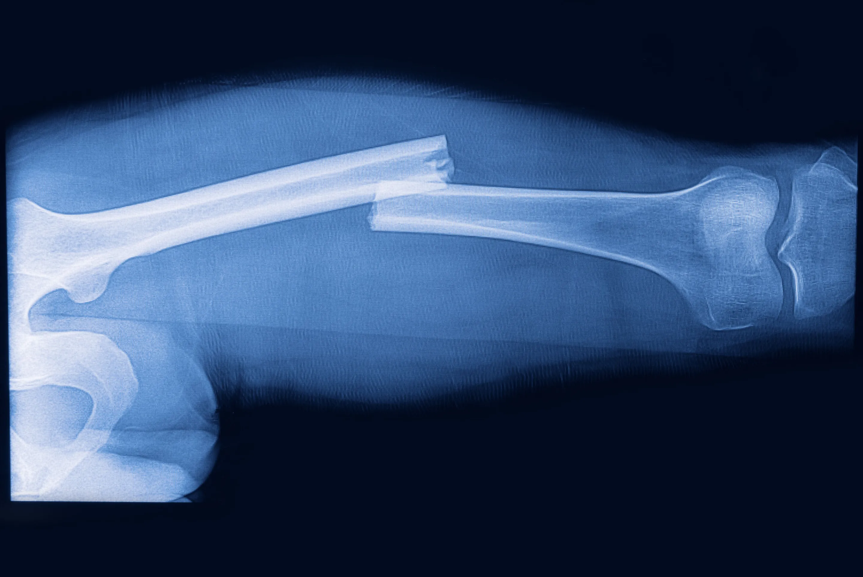A implantable material made from a blend of plastics has been developed to regrow damaged bones (Image: Shutterstock)