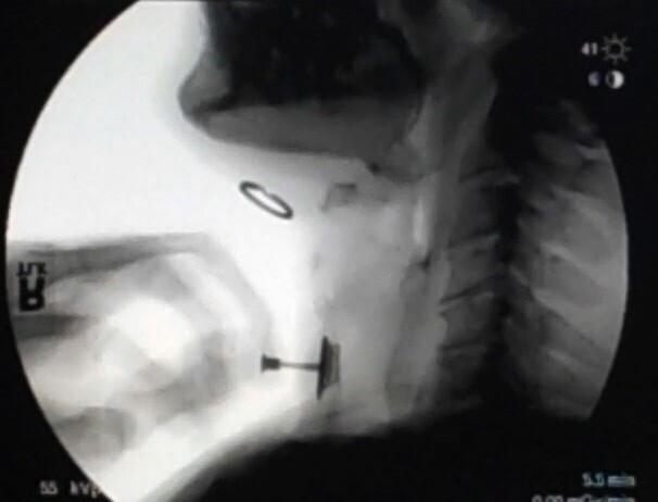 A fluoroscope image of the device in use