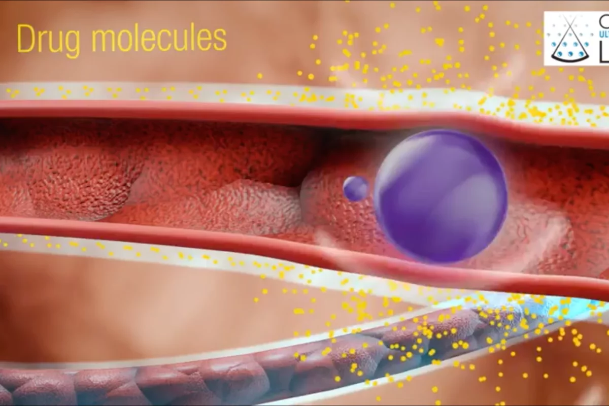 Drug nanoparticles could be delivered directly to the brain through a nasal spray, which is then further targeted to the right area by ultrasound waves