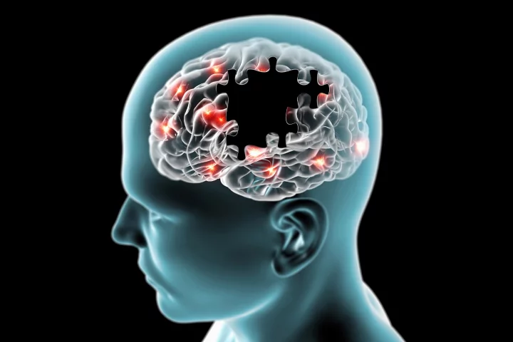New research has revealed frontotemporal dementia results in a person losing the ability to daydream or let their mind wander