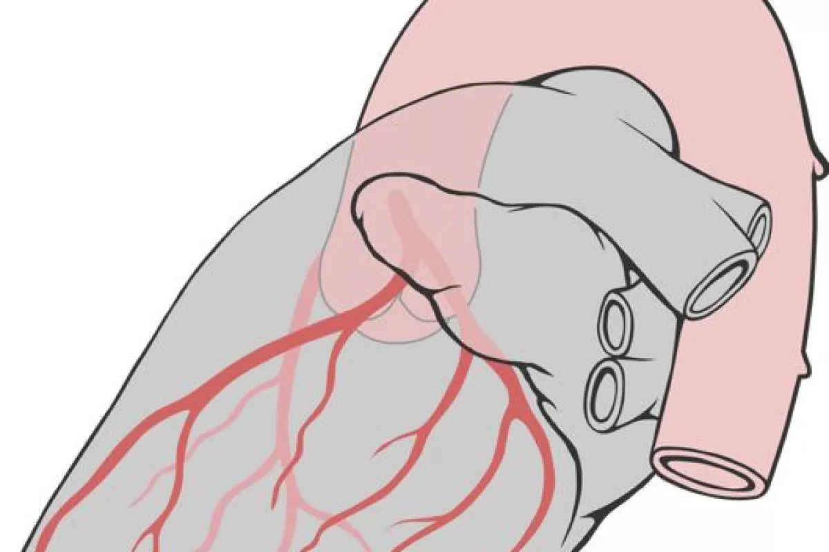A technique that combines nanotechnology with adult stem cells appears to destroy atherosclerotic plaque and rejuvenate arteries (Image: Patrick J. Lynch, medical illustrator)